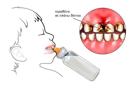 τερηδόνα σε παιδικά δόντια