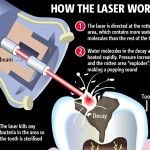 Οδοντιατρικά λέιζερ – laser οδοντιατρικο λειζερ