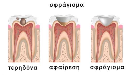 τερηδόνα και σφράγισμα